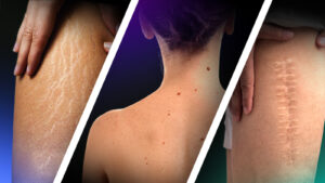 Tatouer sur les grains de beauté, cicatrices et vergetures